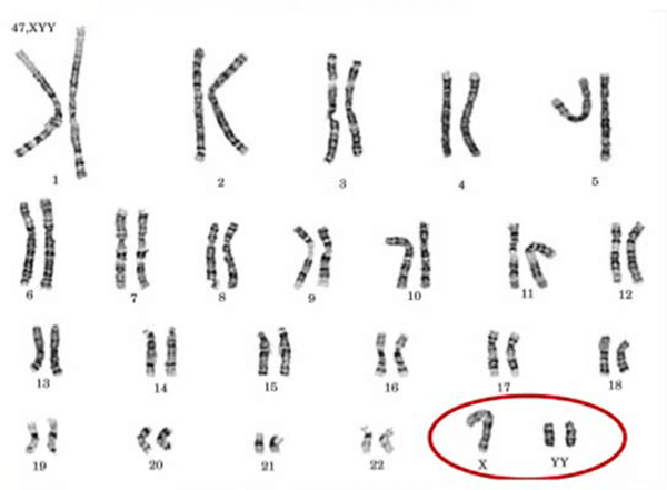 Hội chứng XYY - Hình ảnh minh họa